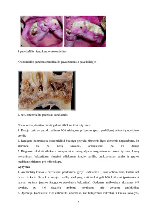 Osteomielitas ir jo reikšmė stomatologijoje. Paveikslėlis 6