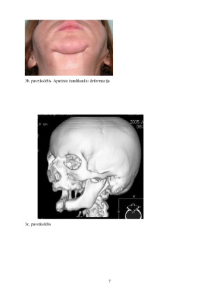 Osteomielitas ir jo reikšmė stomatologijoje. Paveikslėlis 8
