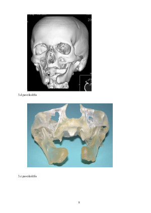 Osteomielitas ir jo reikšmė stomatologijoje. Paveikslėlis 9