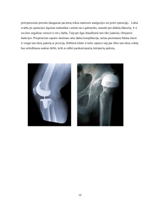 Osteoartritas. Paveikslėlis 10