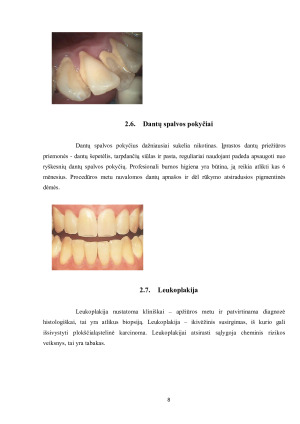 RŪKYMO ĮTAKA BURNOS  SVEIKATAI. Paveikslėlis 8