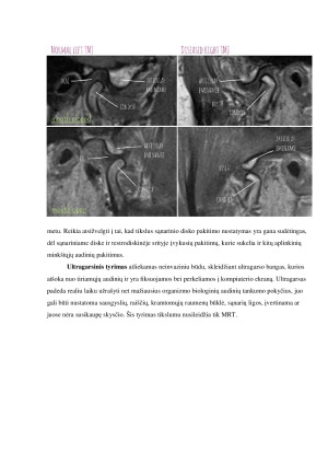 SMILKININIO ŽANDIKAULIO SĄNARIO DISFUNKCIJOS RADIOLOGINĖ DIAGNOSTIKA. Paveikslėlis 6