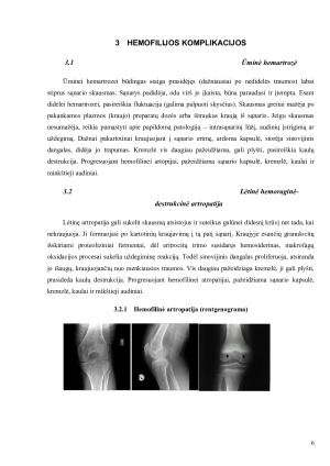Hemofilija. Paveikslėlis 6