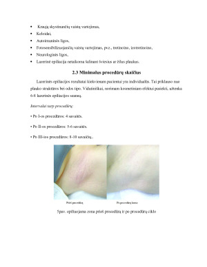 Nepageidaujamų plaukų šalinimas lazeriu bei fotoepiliacijos būdu. Paveikslėlis 9